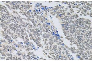 Immunohistochemistry of paraffin-embedded Human lung cancer using PAX3 Polyclonal Antibody at dilution of 1:100 (40x lens). (Paired Box 3 antibody)