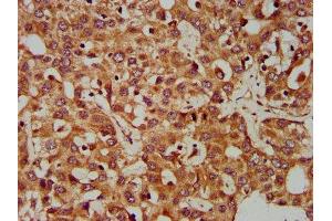IHC image of ABIN7147569 diluted at 1:400 and staining in paraffin-embedded human liver cancer performed on a Leica BondTM system.