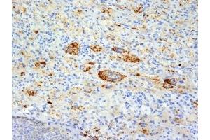 Formalin-fixed, paraffin-embedded human Erdheim Chester disease (also known as polyostotic lerosing histiocytosis) stained with TNF alpha antibody (TNFA/1172).