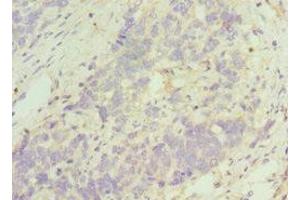 Immunohistochemistry of paraffin-embedded human endometrial cancer using ABIN7161335 at dilution of 1:100 (TACR3 antibody  (AA 356-465))