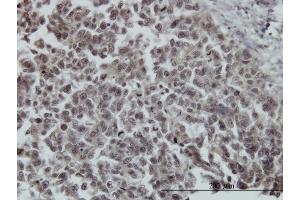 Immunoperoxidase of monoclonal antibody to FOXO3A on formalin-fixed paraffin-embedded human breast cancer. (FOXO3 antibody  (AA 361-460))