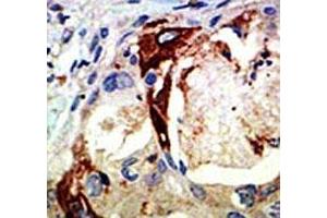 IHC analysis of FFPE human breast carcinoma tissue stained with the Myb antibody (MYB antibody  (AA 506-534))