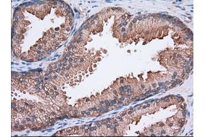 Immunohistochemical staining of paraffin-embedded Adenocarcinoma of Human colon tissue using anti-SNX9 mouse monoclonal antibody. (SNX9 antibody)