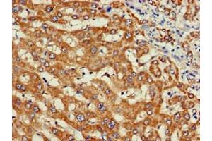 Immunohistochemistry of paraffin-embedded human liver cancer using ABIN7175855 at dilution of 1:100 (WISP3 antibody  (AA 201-372))