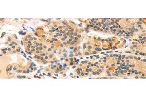 Immunohistochemistry of paraffin-embedded Human thyroid cancer using TUSC5 Polyclonal Antibody at dilution of 1/40
