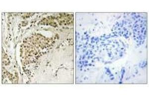Immunohistochemistry analysis of paraffin-embedded human breast carcinoma tissue using NOM1 antibody.