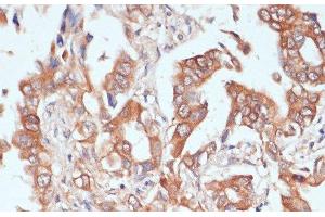 Immunohistochemistry of paraffin-embedded Human lung cancer using PTPRN2 Polyclonal Antibody at dilution of 1:100 (40x lens).