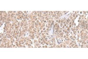 Immunohistochemistry of paraffin-embedded Human ovarian cancer tissue using THAP12 Polyclonal Antibody at dilution of 1:45(x200)