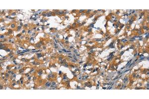 Immunohistochemistry of paraffin-embedded Human thyroid cancer tissue using DDR2 Polyclonal Antibody at dilution 1:40 (DDR2 antibody)