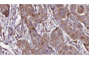 ABIN6276598 at 1/100 staining Human liver cancer tissue by IHC-P. (FCGR1A antibody  (Internal Region))
