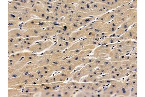 ABIN6259600 and ABIN6275767 at 1/100 staining human liver cancer by IHC-P. (HBAP1 antibody  (Internal Region))