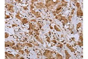 The image on the left is immunohistochemistry of paraffin-embedded Human breast cancer tissue using ABIN7191695(NPR2 Antibody) at dilution 1/45, on the right is treated with synthetic peptide. (NPR2 antibody)