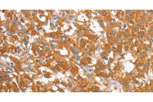 Immunohistochemistry of paraffin-embedded Human thyroid cancer using WNT3A Polyclonal Antibody at dilution of 1:40 (WNT3A antibody)