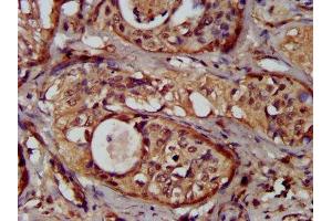 IHC image of ABIN7162085 diluted at 1:300 and staining in paraffin-embedded human cervical cancer performed on a Leica BondTM system. (NUMBL antibody  (AA 447-576))