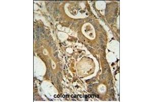 GCNT3 antibody (C-term) (ABIN654928 and ABIN2844571) immunohistochemistry analysis in formalin fixed and paraffin embedded human colon carcinoma followed by peroxidase conjugation of the secondary antibody and DAB staining.