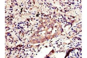 Immunohistochemistry of paraffin-embedded human lung cancer using ABIN7155812 at dilution of 1:100 (Nanog antibody  (AA 1-305))