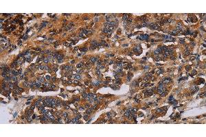 Immunohistochemistry of paraffin-embedded Human breast cancer using KCNQ1 Polyclonal Antibody at dilution of 1:50 (KCNQ1 antibody)