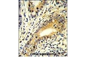 Formalin-fixed and paraffin-embedded human colon carcinoma reacted with FB Antibody (N-term), which was peroxidase-conjugated to the secondary antibody, followed by DAB staining. (FAM3B antibody  (N-Term))
