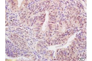 Formalin-fixed and paraffin embedded human breast carcinoma labeled with Rabbit Anti BARD1 Polyclonal Antibody, Unconjugated (ABIN706496) at 1:200 followed by conjugation to the secondary antibody and DAB staining