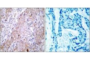 Immunohistochemistry analysis of paraffin-embedded human breast carcinoma tissue, using EGFR (Ab-1070) Antibody. (EGFR antibody  (AA 1041-1090))