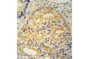 Formalin fixed and paraffin embedded human prostate carcinoma stained with CP013 Antibody (N-term) followed by peroxidase conjugation of the secondary antibody and DAB staining. (C16ORF13 antibody  (N-Term))