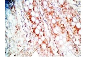 Human colon cancer tissue was stained by Rabbit Anti-Gastrin Releasing Peptide (Porcine) Antibody (Gastrin-Releasing Peptide antibody)