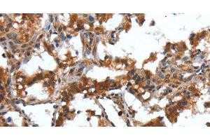 Immunohistochemistry of paraffin-embedded Human thyroid cancer tissue using DEFA4 Polyclonal Antibody at dilution 1:40 (DEFA4 antibody)