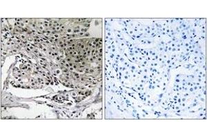 Immunohistochemistry analysis of paraffin-embedded human breast carcinoma tissue, using PIGY Antibody. (PIGY antibody  (AA 3-52))