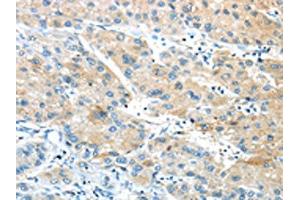 The image on the left is immunohistochemistry of paraffin-embedded Human liver cancer tissue using ABIN7190846(GPR15 Antibody) at dilution 1/20, on the right is treated with synthetic peptide. (GPR15 antibody)