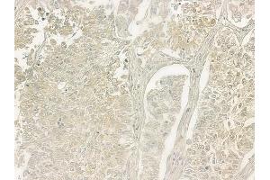 ABIN6257413 and ABIN6275351 at 1/100 staining human lung squamous cell carcinoma by IHC-P. (PEX7 antibody  (C-Term))