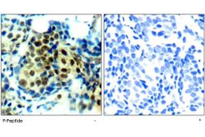 Immunohistochemical analysis of paraffin-embedded human breast carcinoma tissue using MAPK3 (phospho T202) polyclonal antibody . (ERK1 antibody  (pThr202))
