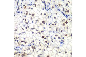 Immunohistochemistry of paraffin-embedded human kidney cancer using GTF2F2 antibody. (GTF2F2 antibody)