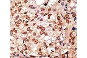 IHC analysis of FFPE human breast carcinoma stained with the SIGLEC7 antibody (SIGLEC7 antibody  (AA 1-30))