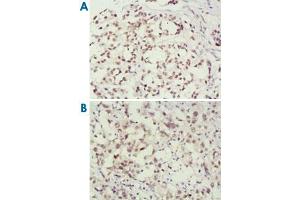 Immunohistochemical analysis of paraffin-embedded human breast cancer (A) and lung cancer (B) tissues, showing nuclear localization using MSH2 monoclonal antibody, clone 3A2B8C  with DAB staining. (MSH2 antibody)