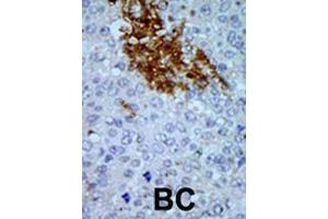 Formalin-fixed and paraffin-embedded human cancer tissue reacted with the primary antibody, which was peroxidase-conjugated to the secondary antibody, followed by AEC staining. (PNCK antibody  (C-Term))