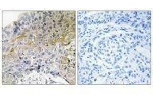 Immunohistochemical analysis of paraffin-embedded human breast carcinoma tissue using p130 Cas (Ab-410) antibody. (BCAR1 antibody  (Tyr410))