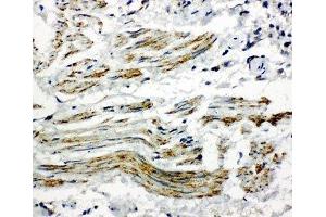 IHC-P: Caveolin-2 antibody testing of human lung cancer tissue (Caveolin 2 antibody  (AA 1-17))