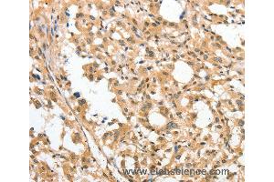 Immunohistochemistry of Human cervical cancer using APTX Polyclonal Antibody at dilution of 1:50