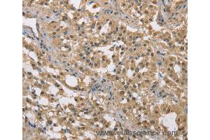 Immunohistochemistry of Human liver cancer using DACH2 Polyclonal Antibody at dilution of 1:40 (DACH2 antibody)