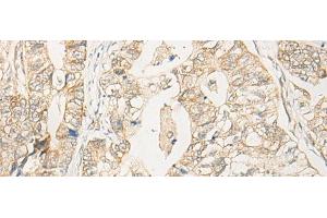 Immunohistochemistry of paraffin-embedded Human gastric cancer tissue using EIF2S2 Polyclonal Antibody at dilution of 1:35(x200) (EIF2S2 antibody)