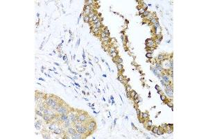 Immunohistochemistry of paraffin-embedded human lung cancer using DFNA5 antibody at dilution of 1:100 (x40 lens). (DFNA5 antibody)