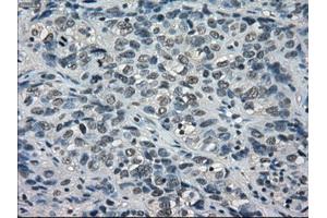 Immunohistochemical staining of paraffin-embedded Carcinoma of thyroid tissue using anti-BUB1Bmouse monoclonal antibody. (BUB1B antibody)