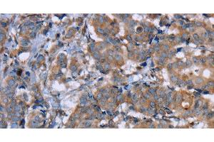 Immunohistochemistry of paraffin-embedded Human breast cancer using PON1 Polyclonal Antibody at dilution of 1:40 (PON1 antibody)