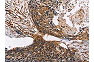 The image on the left is immunohistochemistry of paraffin-embedded Human esophagus cancer tissue using ABIN7190317(CNGA1 Antibody) at dilution 1/40, on the right is treated with synthetic peptide. (CNGA1 antibody)
