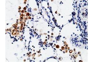 Immunohistochemical staining of paraffin-embedded Adenocarcinoma of Human breast tissue using anti-CD80 mouse monoclonal antibody. (CD80 antibody)