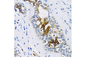 Immunohistochemistry of paraffin-embedded Human breast using PTCH1 antibody (ABIN1682368, ABIN1682367, ABIN3015342, ABIN3015343 and ABIN6213997) at dilution of 1:100 (40x lens). (Patched 1 antibody  (AA 1214-1312))