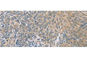 Immunohistochemistry of paraffin-embedded Human cervical cancer tissue using ZHX3 Polyclonal Antibody at dilution of 1:100(x200)