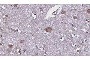 ABIN6275754 at 1/100 staining Human brain cancer tissue by IHC-P. (GNE antibody)