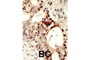 Formalin-fixed and paraffin-embedded human cancer tissue reacted with the primary antibody, which was peroxidase-conjugated to the secondary antibody, followed by DAB staining. (DNMT3L antibody  (C-Term))