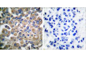 Peptide - +Immunohistochemical analysis of paraffin-embedded human breast carcinoma tissue, using Fibrillin-1 antibody. (Fibrillin 1 antibody)